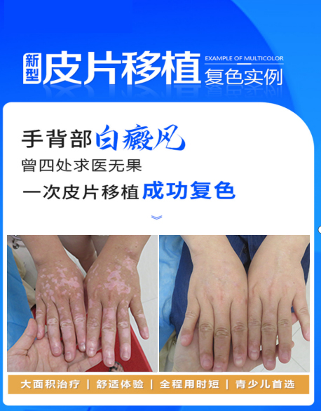 泉州丰泽中科医院超微皮片移植技术 泉州丰泽中科医院超微皮片移植技术